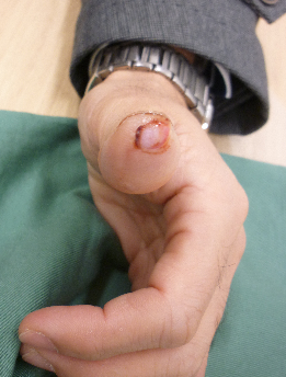 指尖部損傷１゛